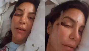 Ivete Sangalo recorre a presilhas de titânio após fratura no rosto