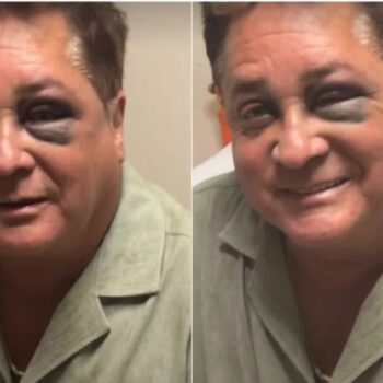 Cantor Leonardo sofre acidente em pescaria e exibe olhos roxos