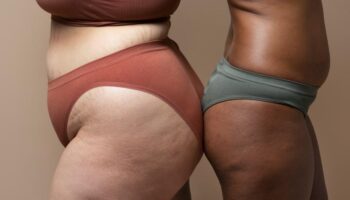 Doença vascular, lipedema causa acúmulo de gordura e dor, exigindo tratamento multidisciplinar